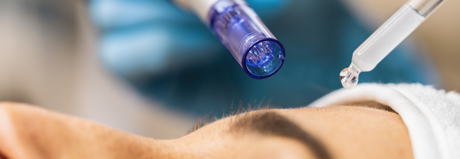 Microneedling karlsruhe