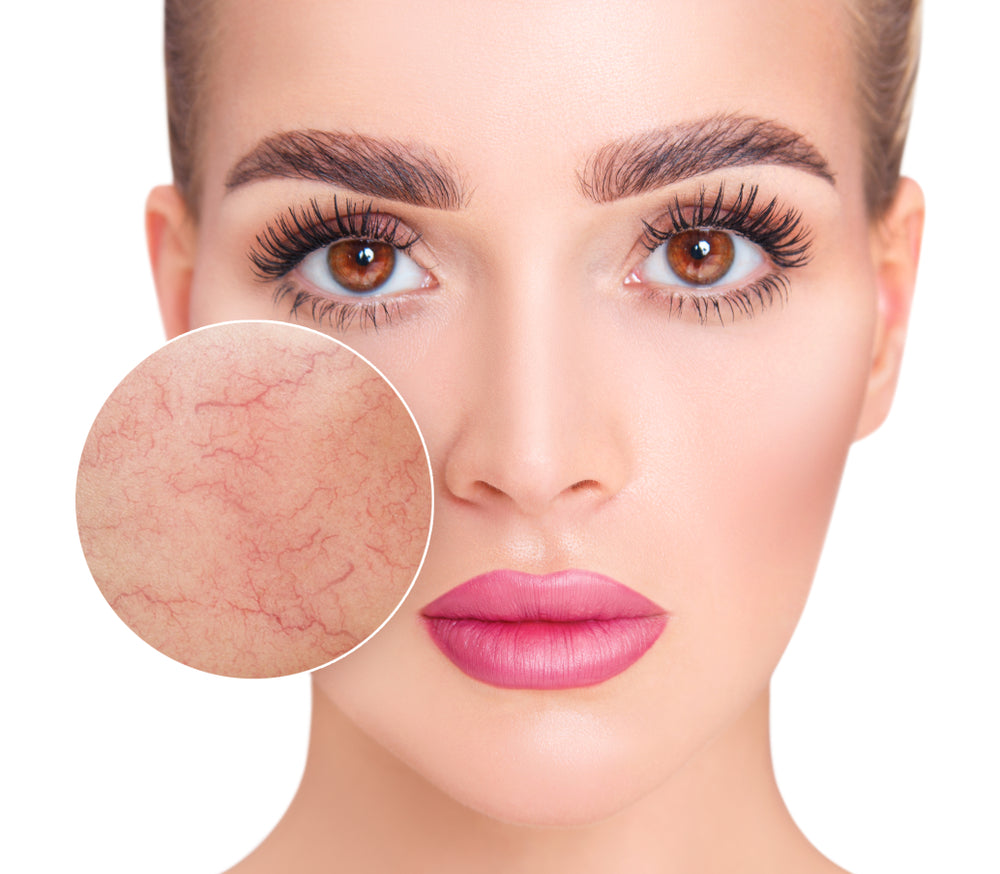 rosacea couperose behandlung karlsruhe