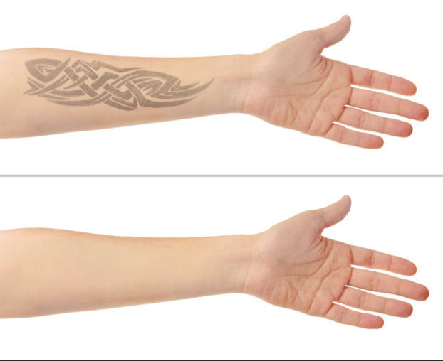 tattooentfernung karlsruhe