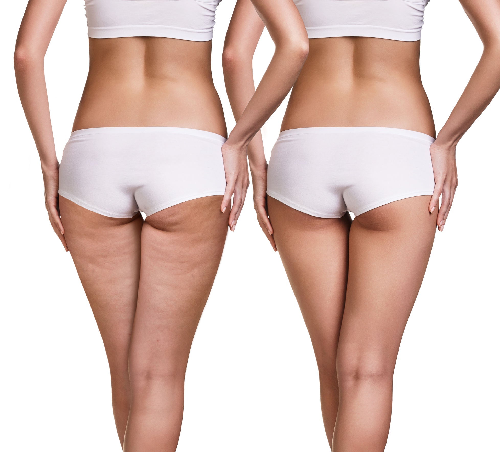 cellulite behandlung